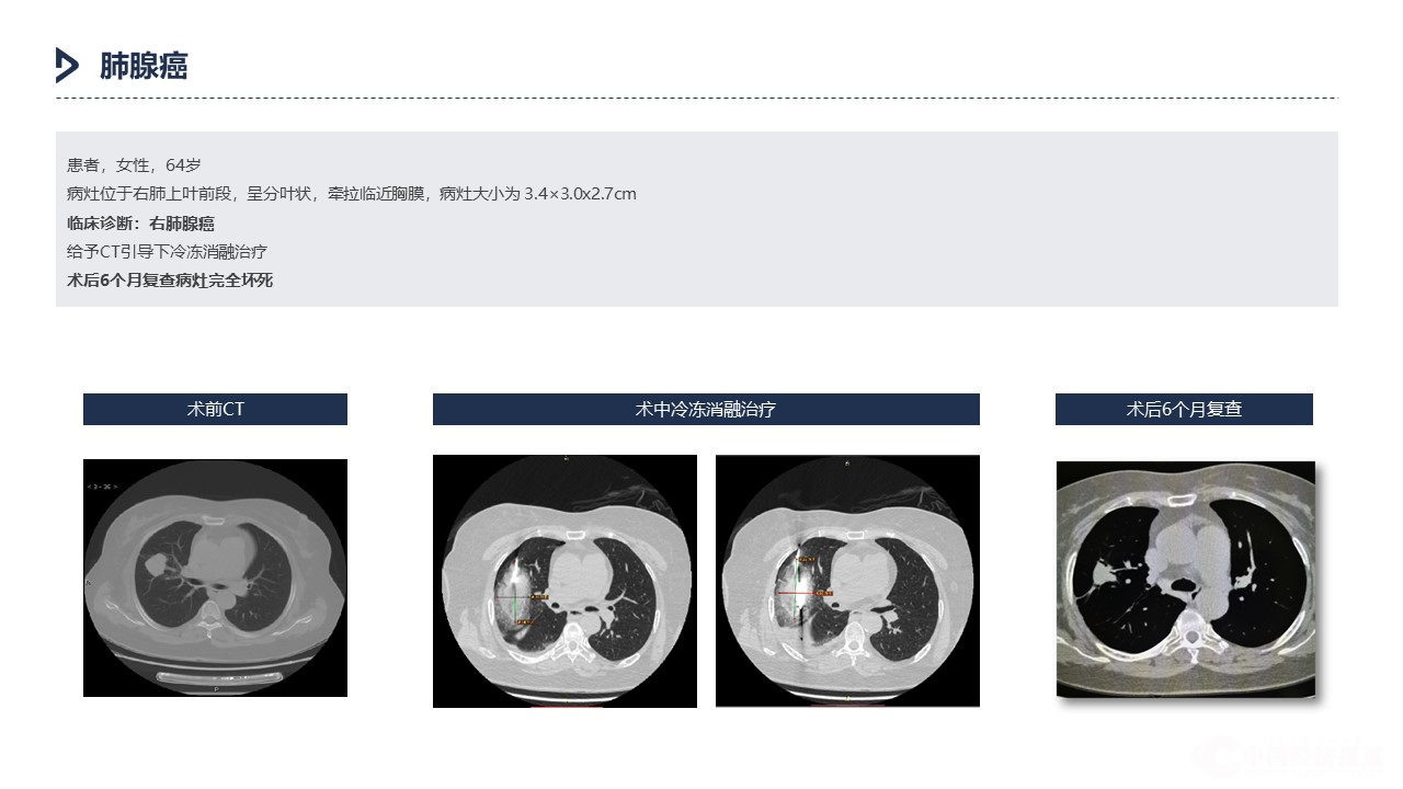 肺部健康新篇章：病例进展喜讯连连