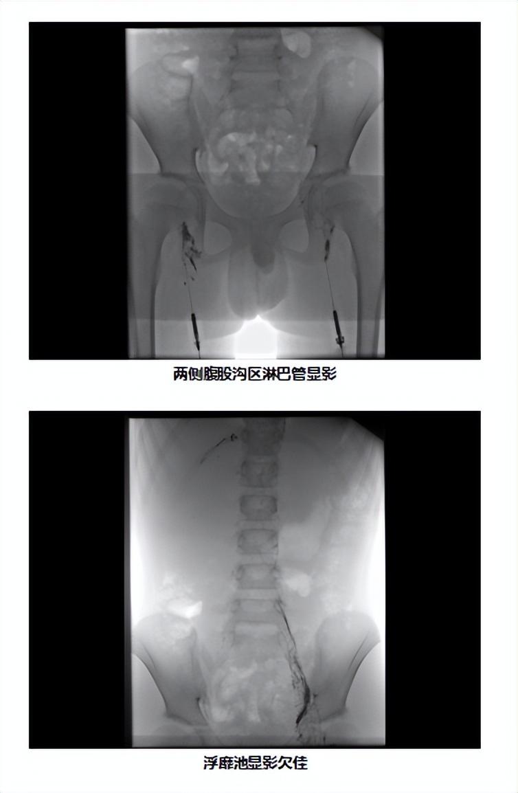 探索前沿：淋巴管畸形治疗的最新突破与进展